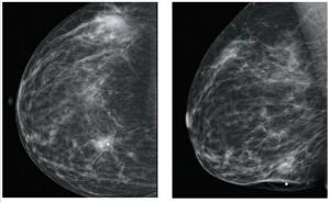 A 35-Year-Old Woman With a Change in HER2 Expression Following Neoadjuvant Chemotherapy for Invasive Breast Cancer