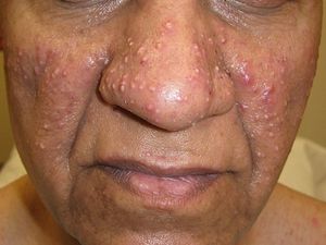 Epidermal Growth Factor Receptor Inhibitor Cutaneous Side Effects