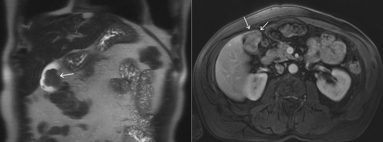 Right Upper Quadrant Pain in Abdomen of 60-Year-Old Patient | Cancer