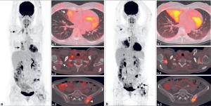 What Are Treatment Options After Progression in PDL-1–Positive Metastatic Lung Adenocarcinoma after Chemo/IO?