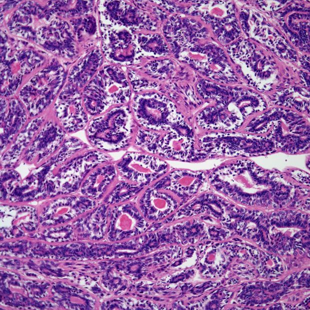 Bronchial Mass Found in 44-Year-Old Patient | Cancer Network