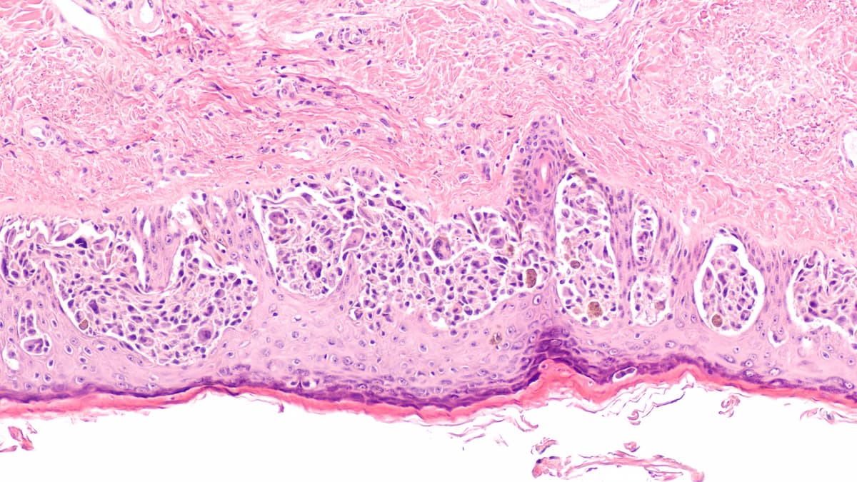 Fianlimab/Cemiplimab Yields Activity in Pretreated Metastatic Melanoma | Image Credit: © David A Litman - stock.adobe.com.