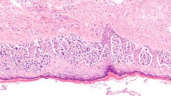 Adjuvant Nivolumab Earns European Approval in Resected Stage IIB/C Melanoma | Image Credit: © David A Litman - stock.adobe.com.