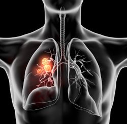 Despite Poor Prognosis, Anlotinib May Improve PFS in Pre-Treated NSCLC With Liver Metastases in Later Lines