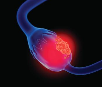 Ovarian Cancer