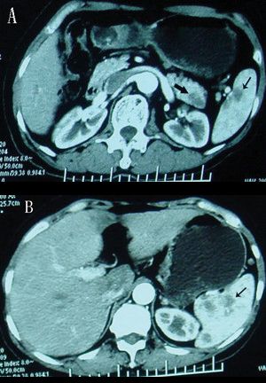 Pancreatic cancer phd thesis