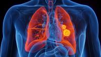 3D Rendered Medical Illustration of Male Anatomy - Lung Cancer. | Image Credit: © Sebastian Kaulitzki - stock.adobe.com.