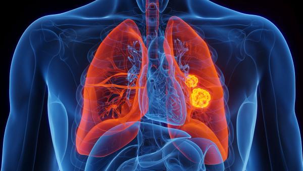 3D Rendered Medical Illustration of Male Anatomy - Lung Cancer. | Image Credit: © Sebastian Kaulitzki - stock.adobe.com.
