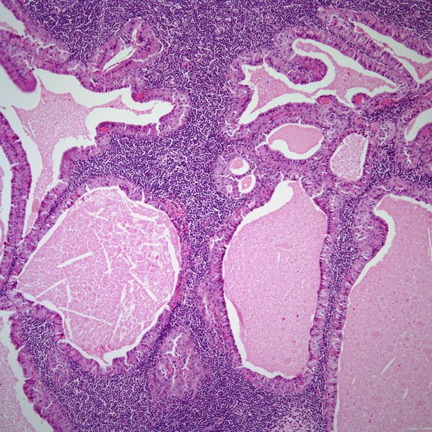 Parotid Mass in 53-Year-Old Patient | Cancer Network