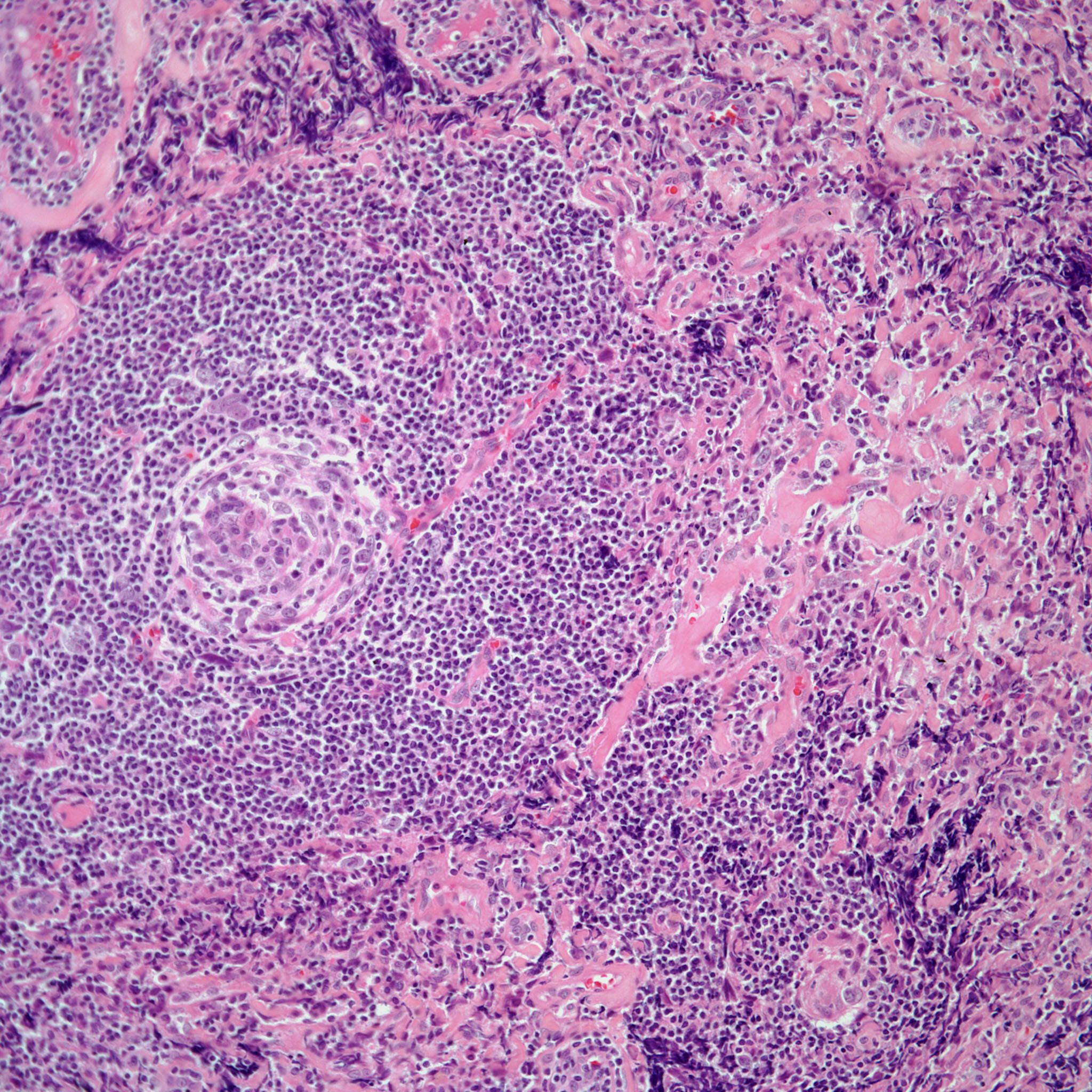 What Caused The Enlarged Lymph Node In This Otherwise Healthy Man s Neck what-caused-the-enlarged-lymph-node-in-this-otherwise-healthy-man-s-neck
