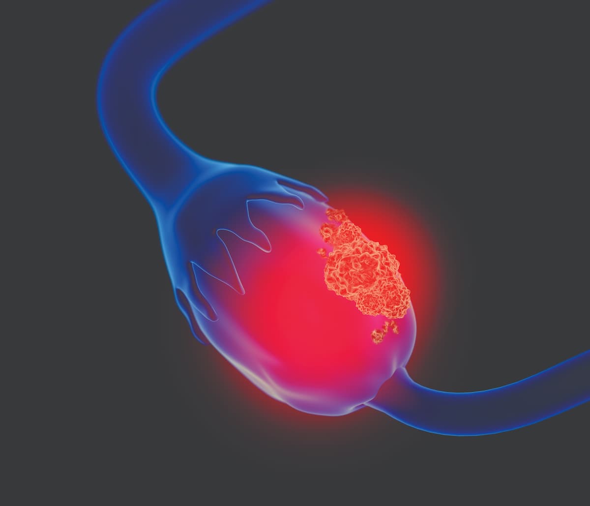 Investigators of the phase 3 PAOLA-1 trial stated that "all women with BRCA1/BRCA2 mutations" in ovarian cancer may "derive benefit from maintenance therapy with olaparib and bevacizumab."
