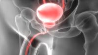 Those with intellectual disabilities were less likely to undergo expedient prostate biopsy following an elevated PSA result.