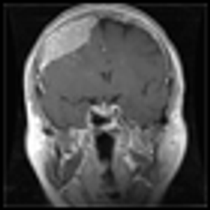 Primary and Metastatic Brain Tumors