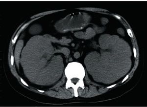 Acute Kidney Injury in Patients With Cancer