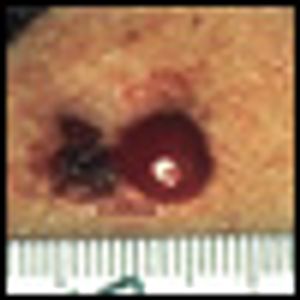 Treatment of Metastatic Melanoma: An Overview