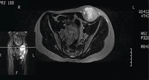 Pediatric Locally Advanced Synovial Sarcoma: What Would Be the Best Treatment Option?