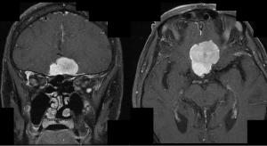 'Cloudy Vision' in Patient With Rectal Cancer History