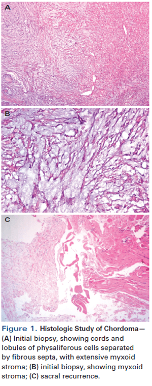 Man With Recurring Chordoma and Progressive Disease Despite Radiotherapy and Radical Resection