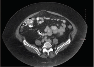 Mucinous Adenocarcinoma of the Appendix With Histologic Response to Neoadjuvant Chemotherapy: Review of Histologic and Clinical Spectrum of Epithelial Neoplastic Mucinous Lesions of the Appendix