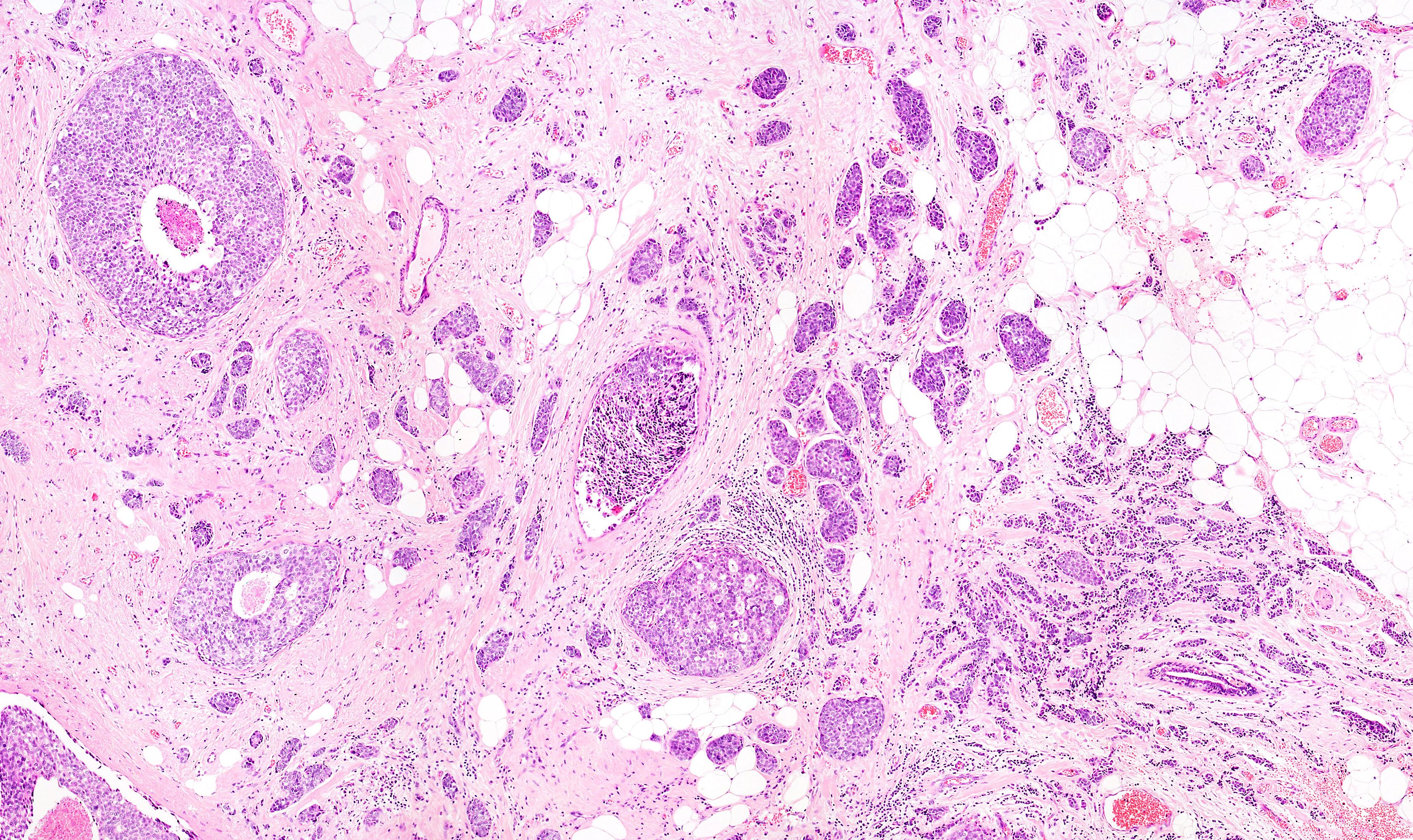 breast cancer