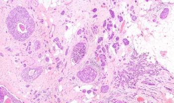 breast cancer