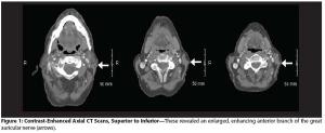 Squamous Cell Carcinoma Recurring to the Great Auricular Nerve