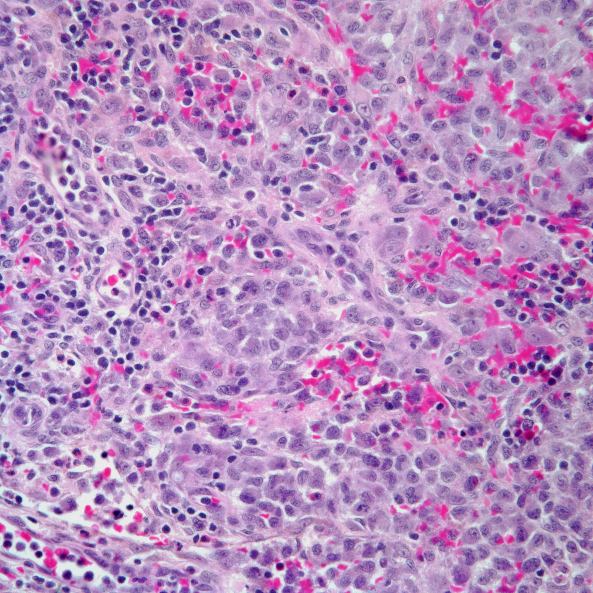 Fatigue And A Sense Of Malaise In A Woman With An Enlarged Cervical