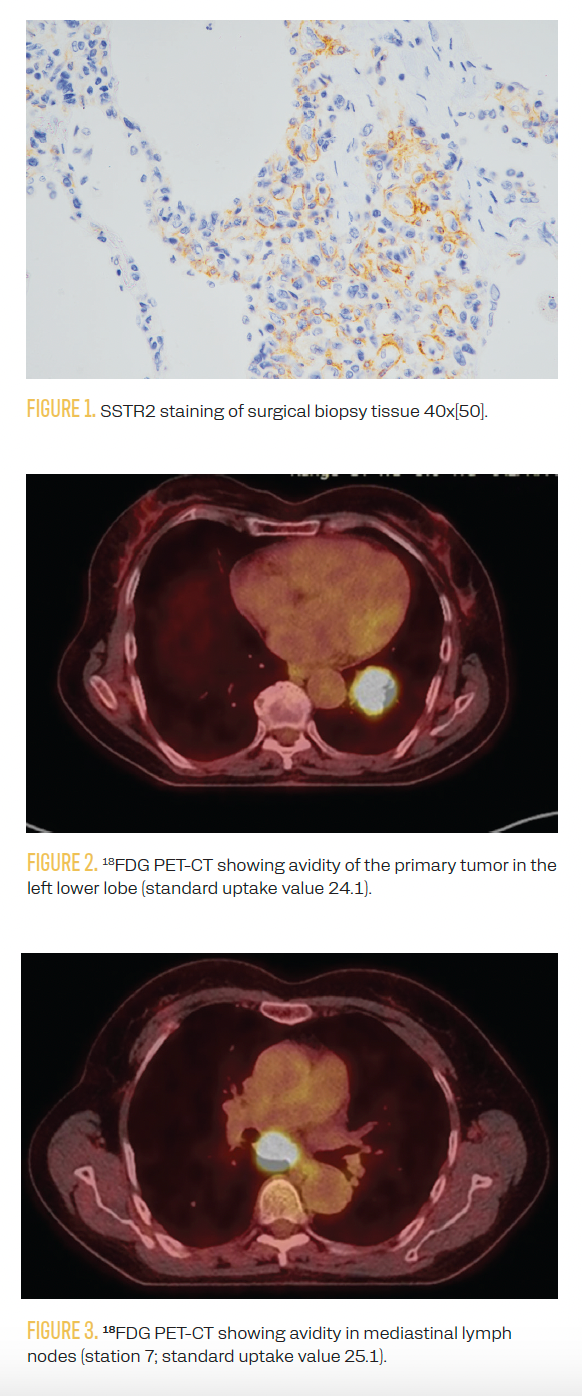 Neoadjuvant Capecitabine Plus Temozolomide in Atypical Lung NETs