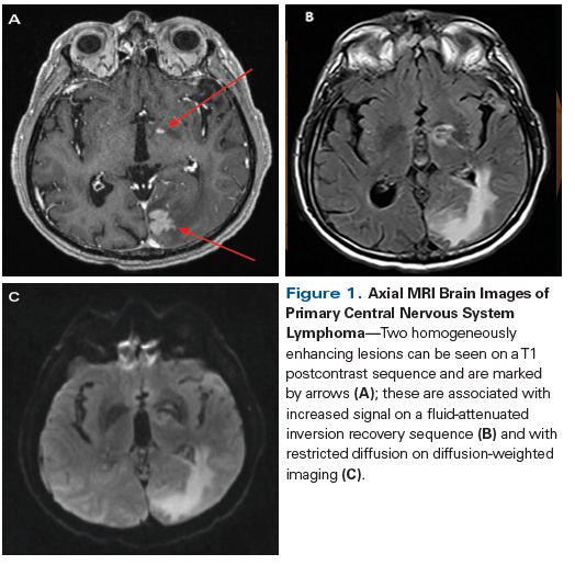 Primary Central Nervous System Lymphoma Part 1 Epidemiology Diagnosis Staging And Prognosis