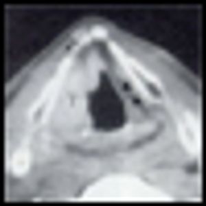 Management of Locally Advanced or Unresectable Head and Neck Cancer