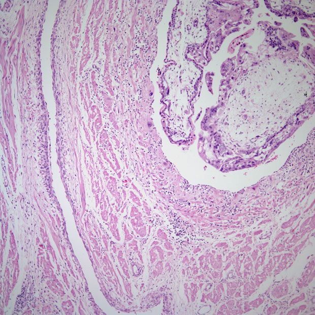 Data from a phase 1/2 trial support the fast track designation for tulmimetostat as a treatment for patients with ARID1A-mutated advanced, recurrent or metastatic endometrial cancer.