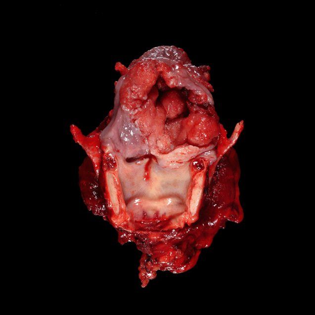 Slide Show Squamous Cell Carcinoma of the Head and Neck