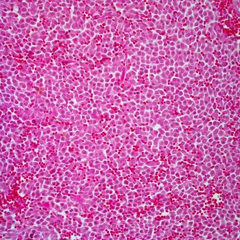 Data from the phase 2 PIONEER trial supports the supplemental new drug application for avapritinib in adult patients with indolent systemic mastocytosis, an uncontrolled proliferation and activation of mast cells.