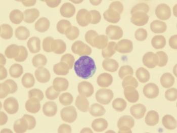 Real-World Data Supports Use of Hypomethylating Drugs in Elderly Patients With Acute Myeloid Leukemia