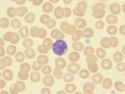 Real-World Data Supports Use of Hypomethylating Drugs in Elderly Patients With Acute Myeloid Leukemia