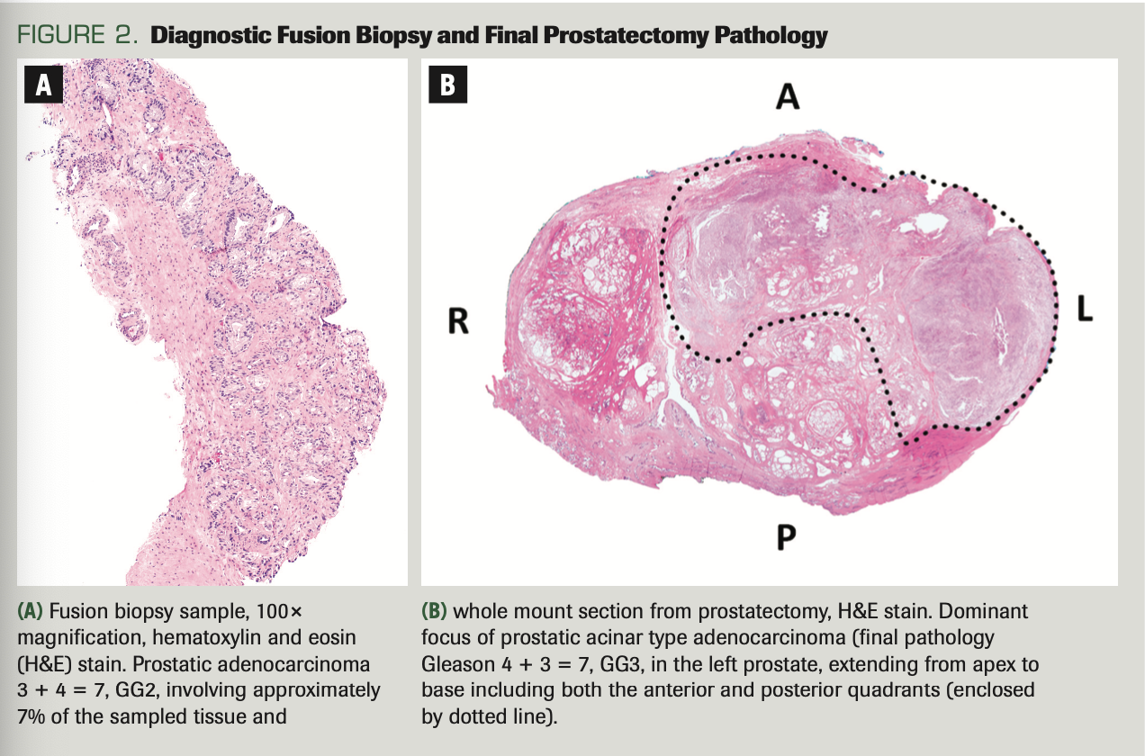 FIGURE 2. Diagnostic Fusion Biopsy and Final Prostatectomy Pathology

(A) Fusion biopsy sample, 100× magnification, hematoxylin and eosin (H&E) stain. Prostatic adenocarcinoma 3 + 4 = 7, GG2, involving approximately 7% of the sampled tissue and



(B) whole mount section from prostatectomy, H&E stain. Dominant focus of prostatic acinar type adenocarcinoma (final pathology Gleason 4 + 3 = 7, GG3, in the left prostate, extending from apex to base including both the anterior and posterior quadrants (enclosed by dotted line).