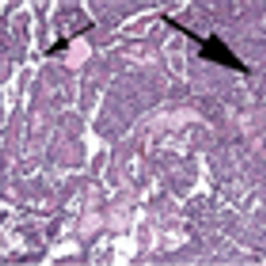 Collision Renal Cell Papillary and Medullary Carcinoma in a 66-Year-Old Man