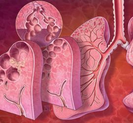 Understanding the Links Between Lung Cancer, COPD, and ...