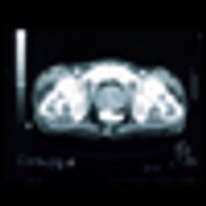 Prostate Cancer: What Did We Learn From the 2012 Annual Scientific Meeting of ASCO?