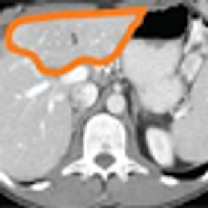 Colorectal Cancer Patients With Oligometastatic Liver Disease: What Is the Optimal Approach?