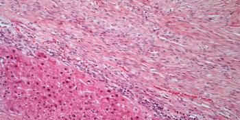 Data from the phase 3 RATIONALE-301 trial appear to support tislelizumab as a potential frontline treatment option for patients with unresectable hepatocellular carcinoma.