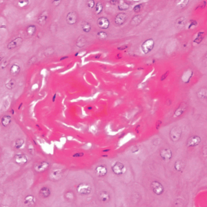 Squamous Cell Carcinoma of the Kidney: A Large Case Series
