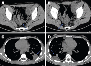 How to Treat Metastatic Malignant Triton Tumor in an Adolescent