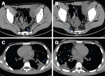 How to Treat Metastatic Malignant Triton Tumor in an Adolescent