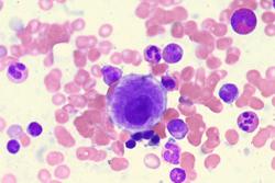 Allo-HCT From Younger Matched Unrelated Donors Yields High DFS, Low Recurrence in MDS