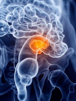 Patients With Advanced CRC May Experience Survival Benefit With Lenvatinib Plus Pembrolizumab Combo