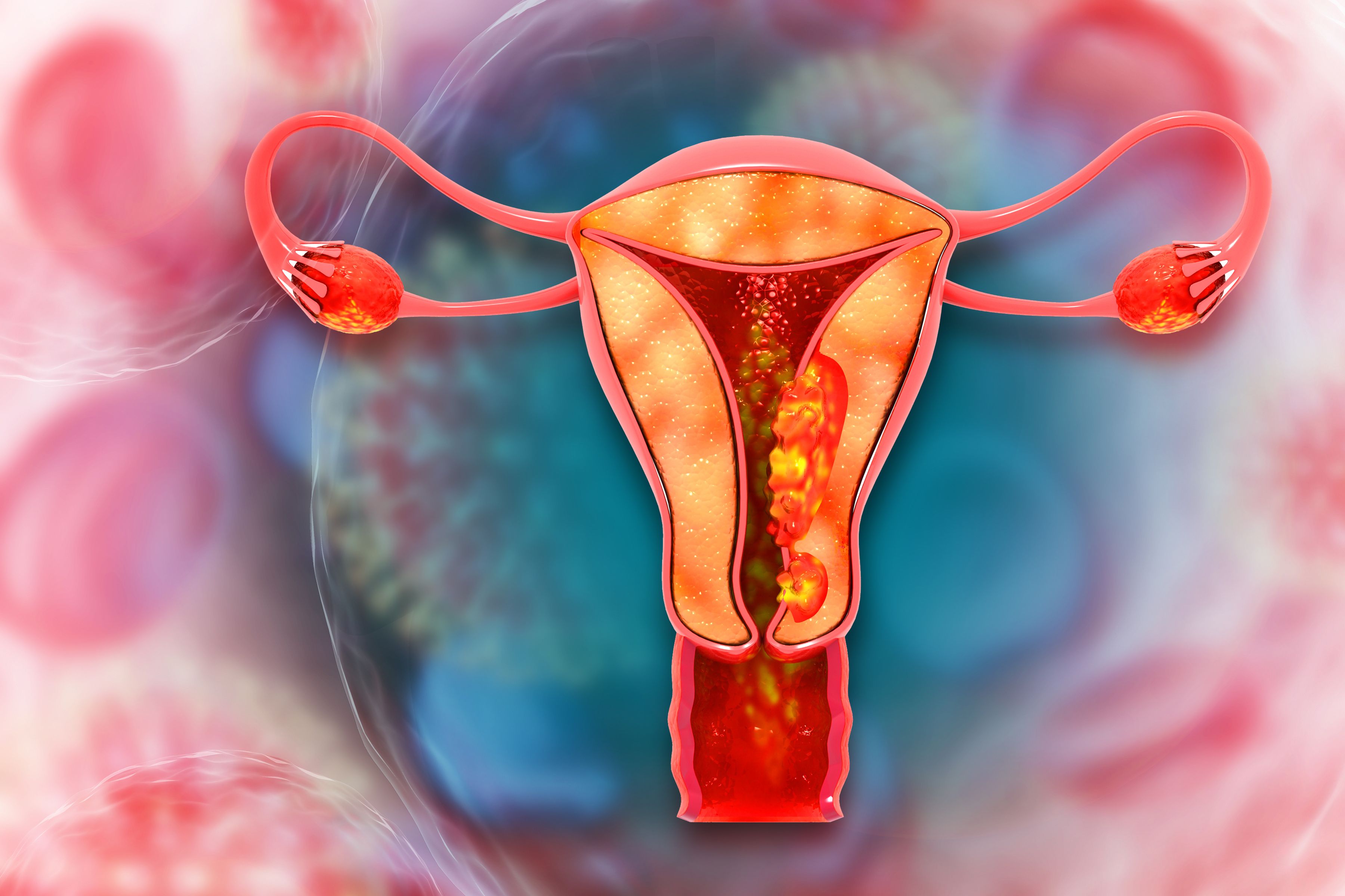 Pembrolizumab Monotherapy Improves PFS in dMMR Endometrial Cancer: © Crystal light - stock.adobe.com