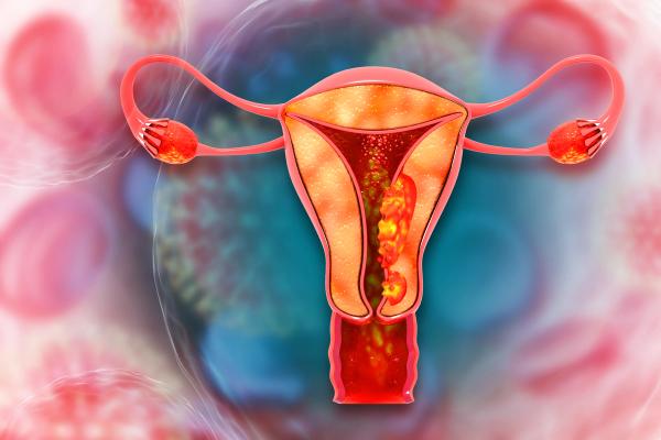 Pembrolizumab Monotherapy Improves PFS in dMMR Endometrial Cancer: © Crystal light - stock.adobe.com