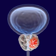 Prostate cancer, 3D illustration showing presence of tumor inside prostate gland which compresses urethra | Image Credit: © Dr Microbe - stock.adobe.com