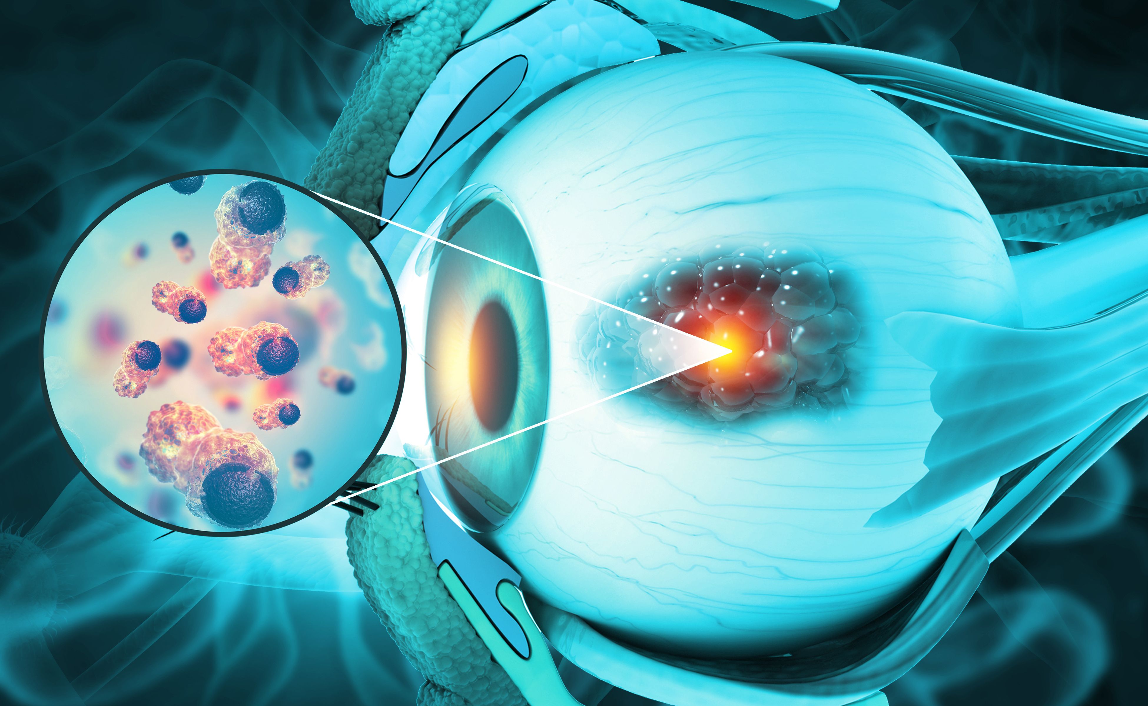 Darovasertib Combo Improves PFS in Metastatic Uveal Melanoma Trial